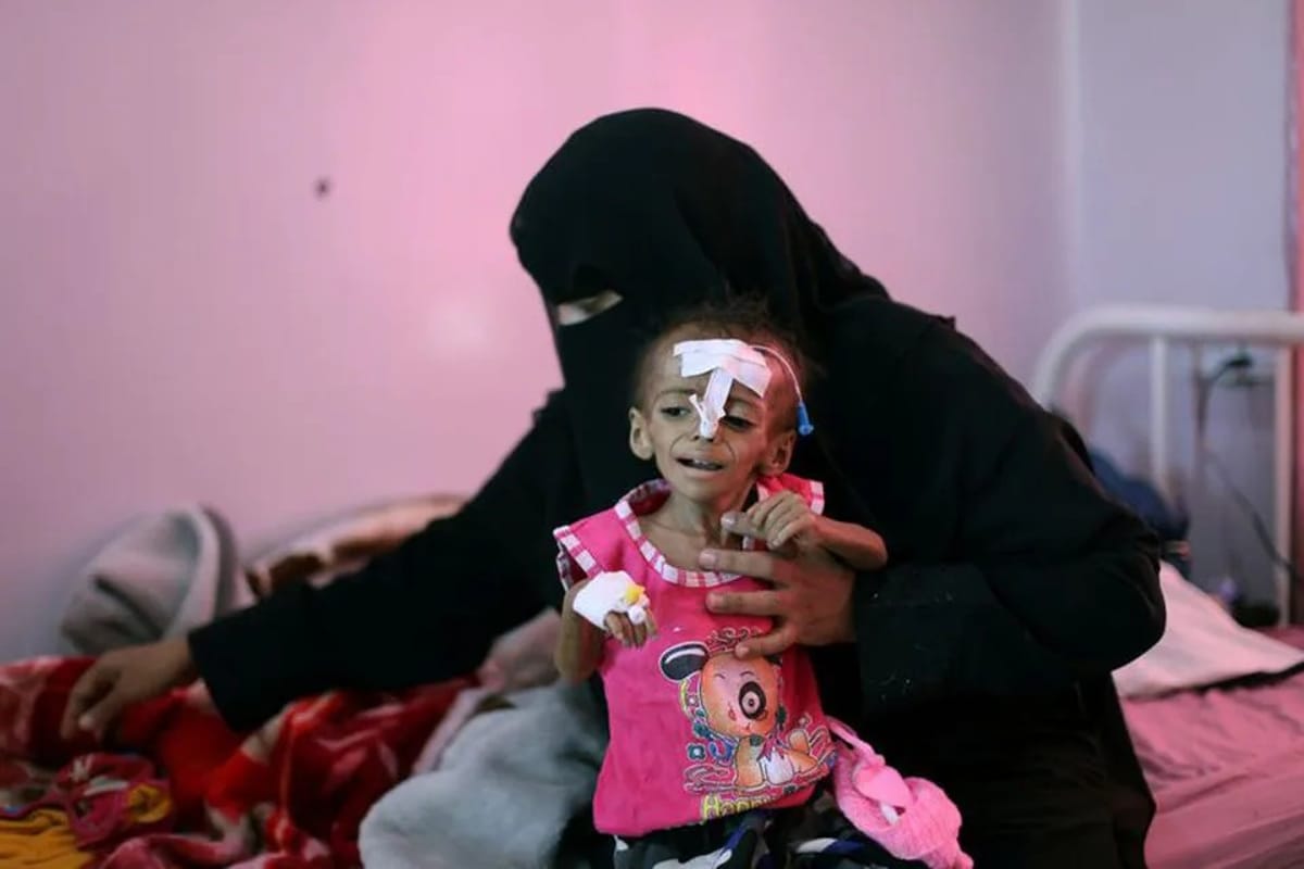 وفاة 36 طفلا وإصابة 7 آلاف بمرض الحصبة في مناطق سيطرة الحكومة 