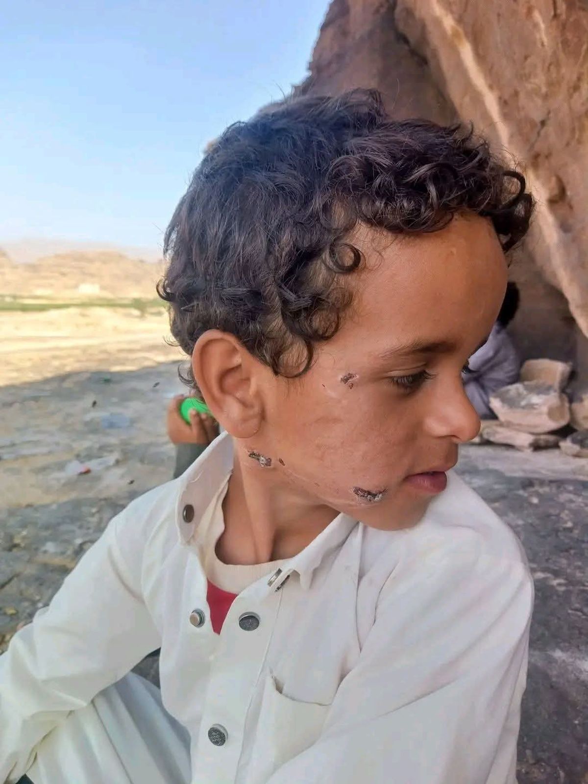 مناشدات لإنقاذ طفل من داء الكلب في صعدة