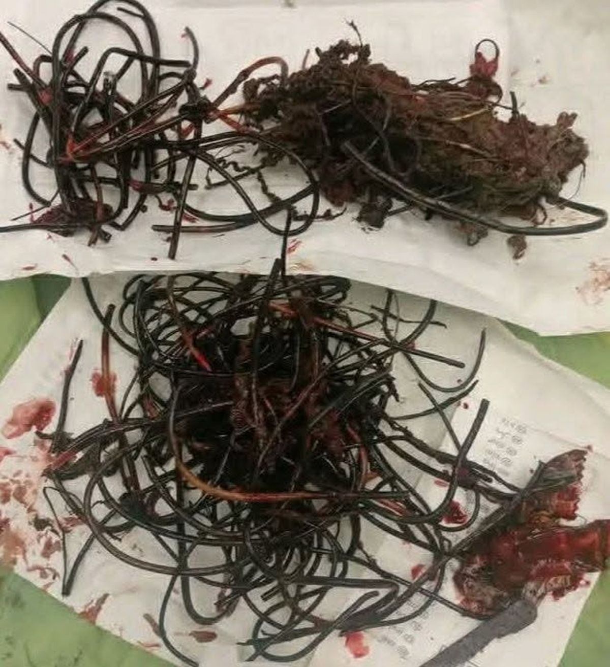 أسلاك وأكياس بلاستيكية في معدة طفل.. أطباء تعز ينجحون في عملية نادرة