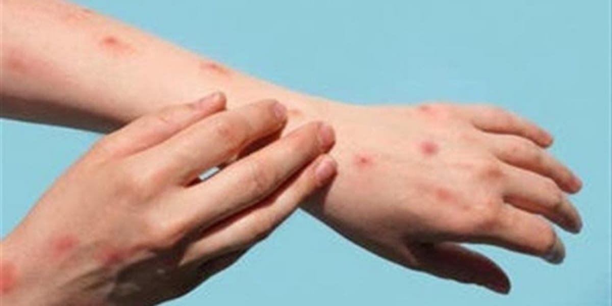 وزارة الصحة تنفي رصد أي إصابة بجدري القردة في اليمن