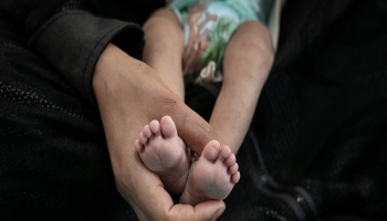 الطفلة إيثار (4 شهور) تعاني من سوء التغذية في صنعاء باليمن -