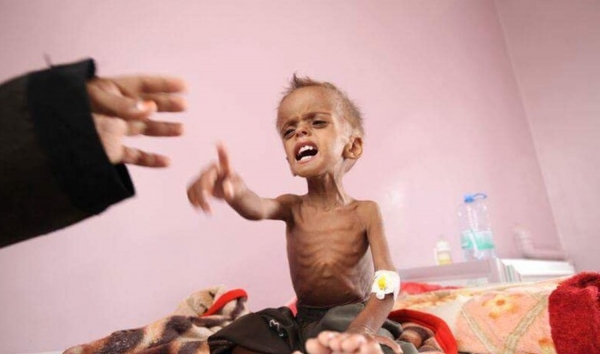 الأمم المتحدة تحذر من تفاقم سوء التغذية على الأطفال في اليمن