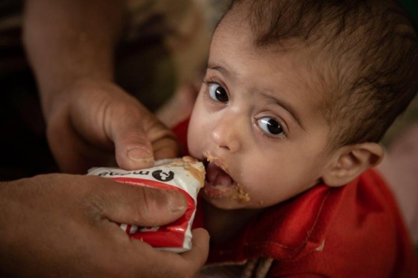 طفل يمني مصاب بسوء التغذية