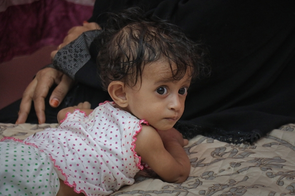 الصحة العالمية تعلن علاج 2255 طفلا مصابا بسوء التغذية في اليمن