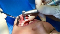 أمراض الفم والأسنان تنذر بخطر الإصابة بنوبة قلبية