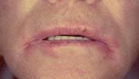 أطباء يحذرون: تشقق زوايا الفم قد ينجم عن أسباب خطيرة