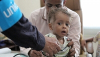"يونيسف" تتلقى دعماً أمريكاً بقيمة 30 مليون دولار لمواجهة سوء التغذية الحاد باليمن